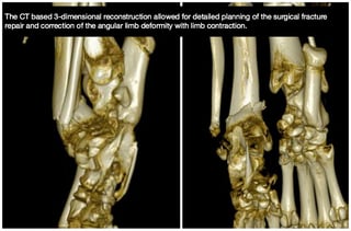 CT-tiger-fracture-3D.jpg CT-tiger-fracture-3D.jpg